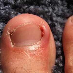 Ingrowing Toenails