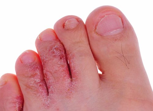 Athlete’s Foot & other Infections