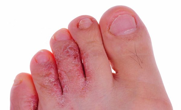 Athlete’s Foot & other Infections