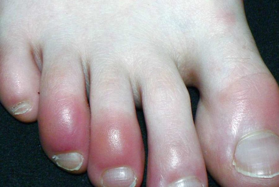 Pain in toenail when pressed What’s Causing The Pain In Your Toenail?