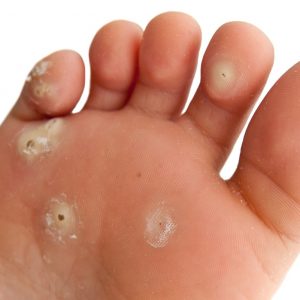 Verruca Infection