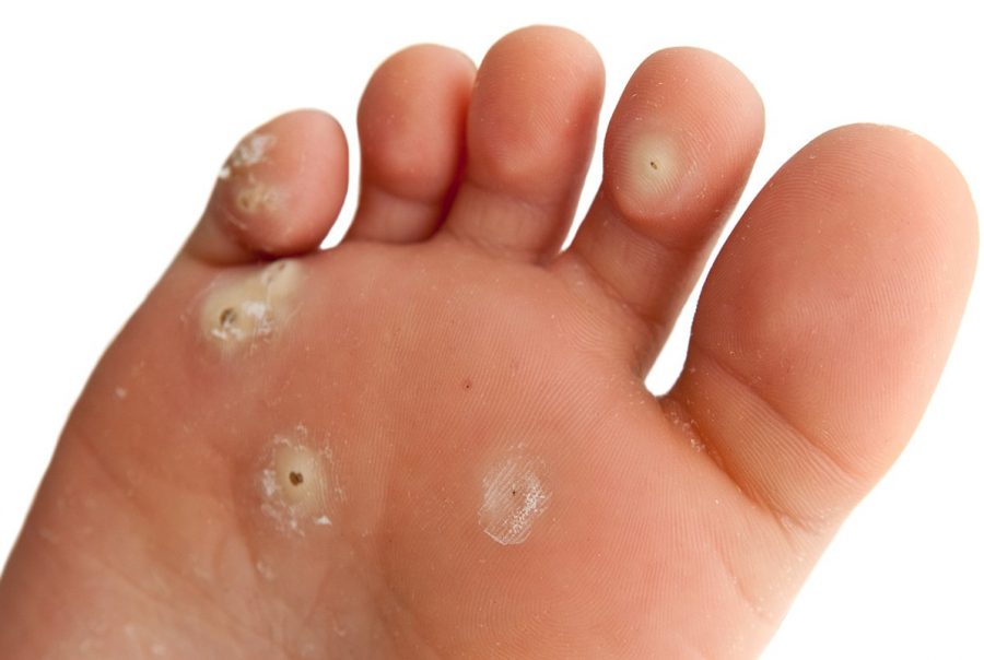 Verruca treatment will get rid of a verruca fast and safely