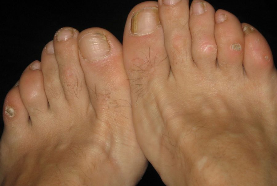 What’s A Corn & How To Treat Corns Simple Foot Problems