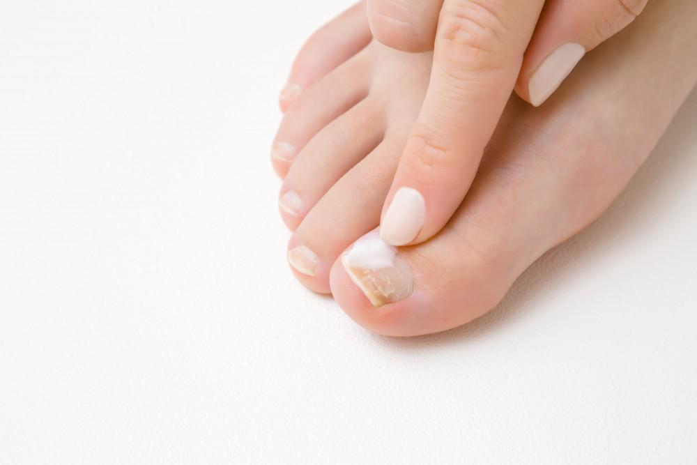 Fungal Nail Treatment Midland | Relief for Fungal Toenails