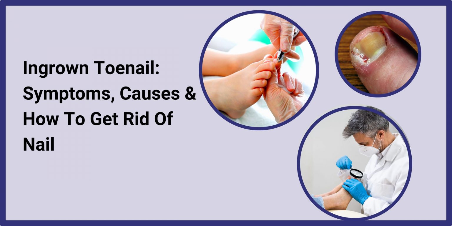 Ingrown Toenail Symptoms, Causes & How to Get Rid of Nail