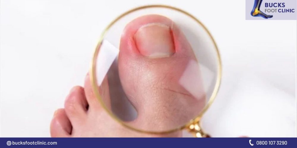 How To Treat An Infected Corn & Ingrown Toenail Complication
