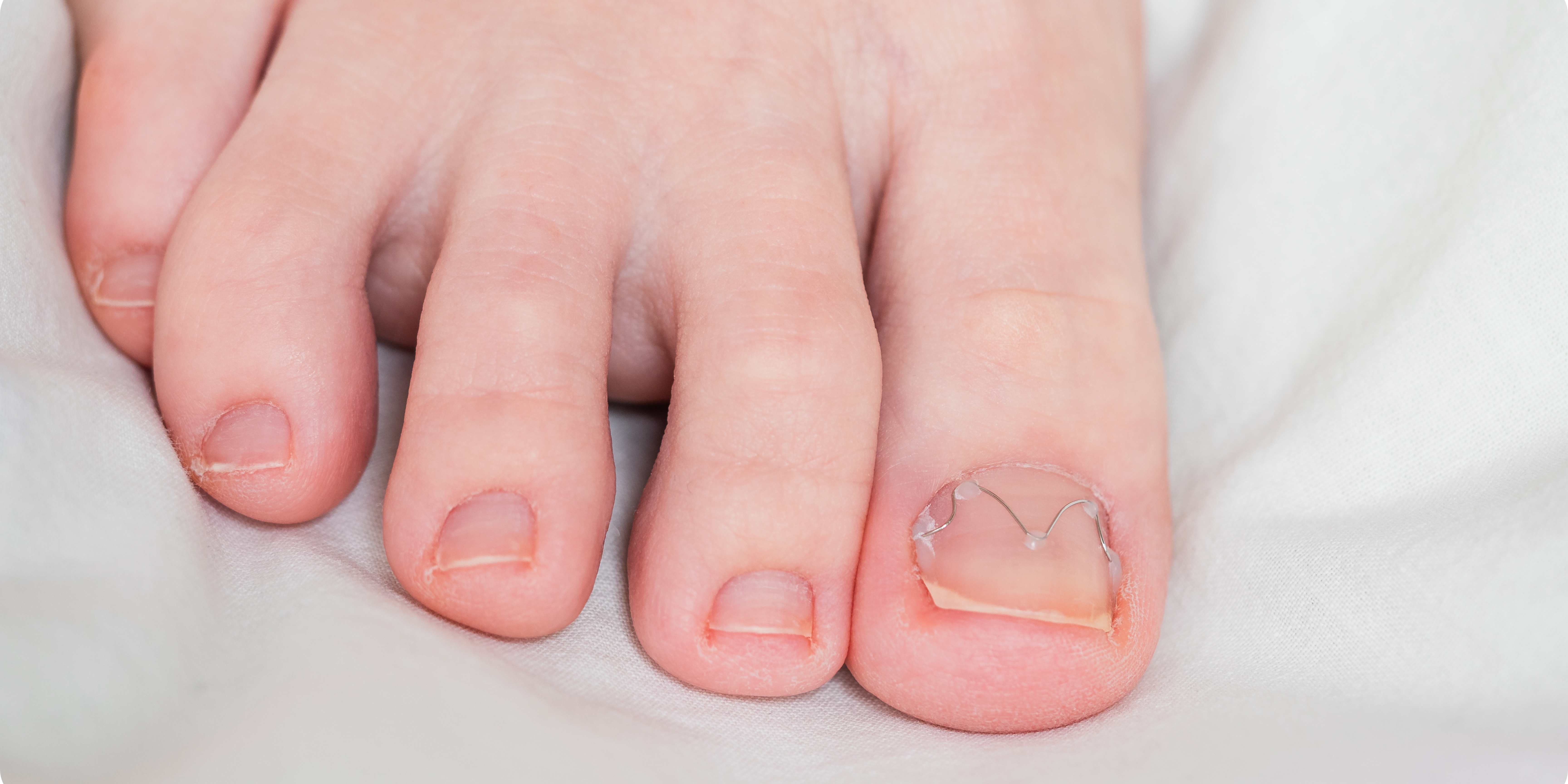 What to Do for Ingrown Toenails & How Epsom Salts Help