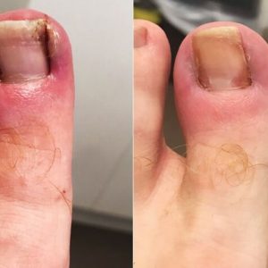 Ingrown Toenail Non-Surgical Treatment