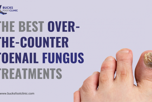 Toenail fungus treatment Amersham