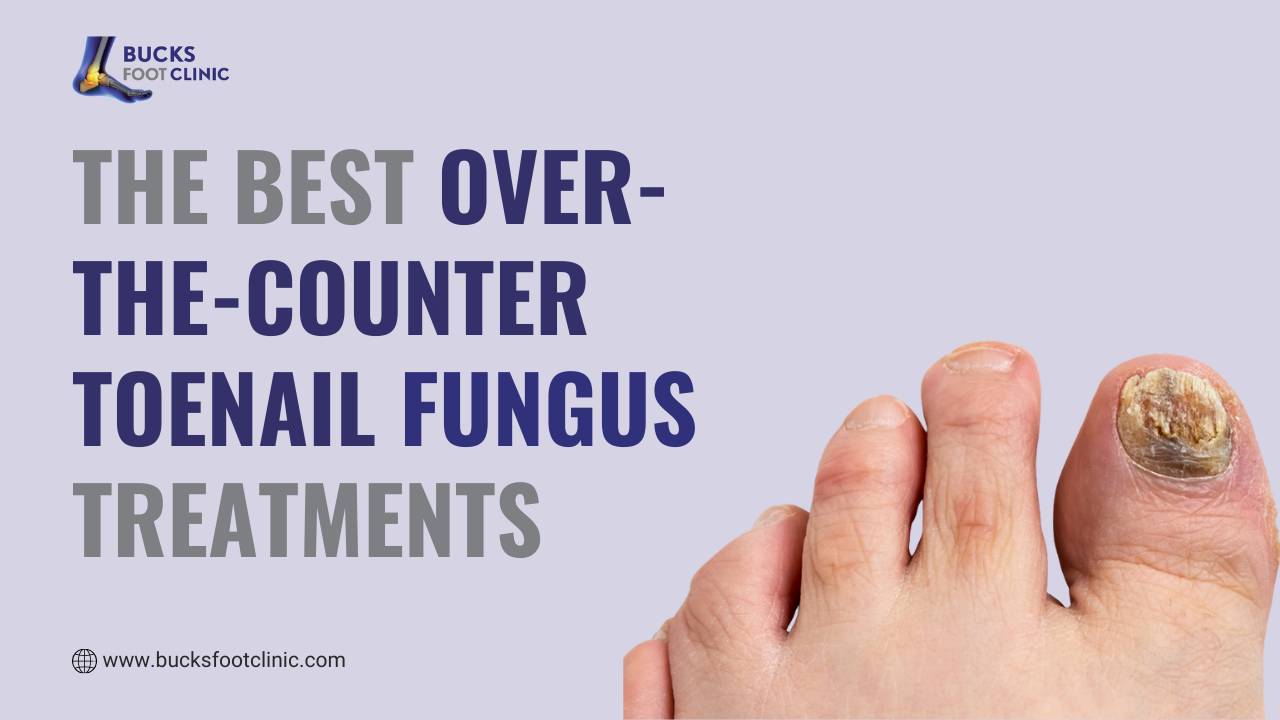 Toenail fungus treatment Amersham