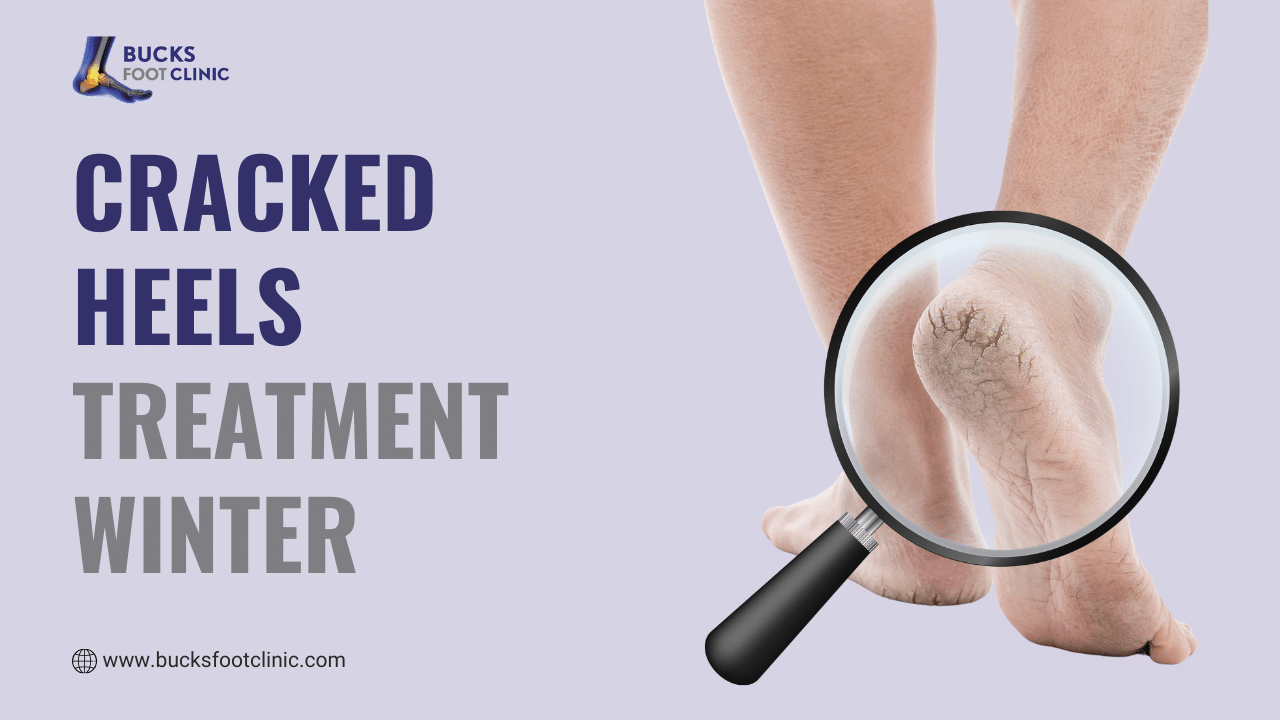 Cracked heels treatment winter
