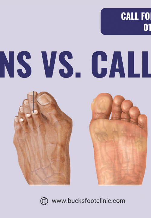 Corns vs. Calluses