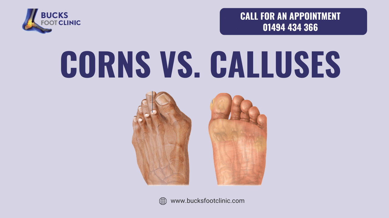Corns vs. Calluses