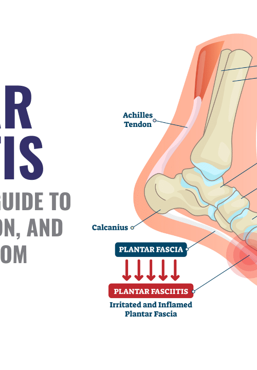 Plantar Fasciitis