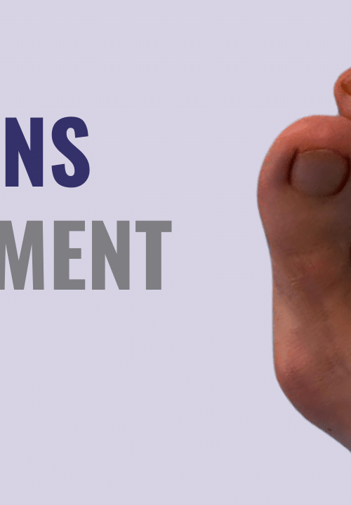 bunions treatment guide