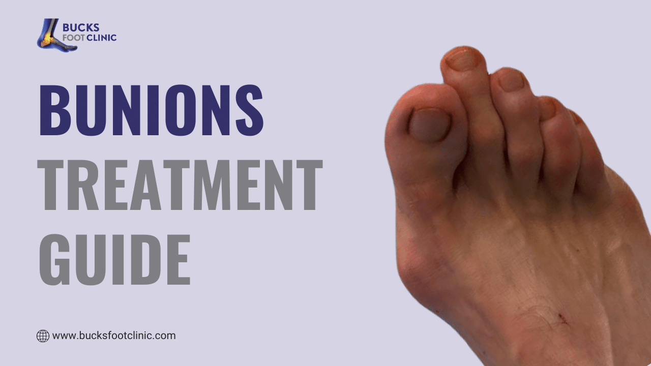 bunions treatment guide