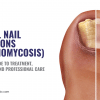 Fungal Nail Infections