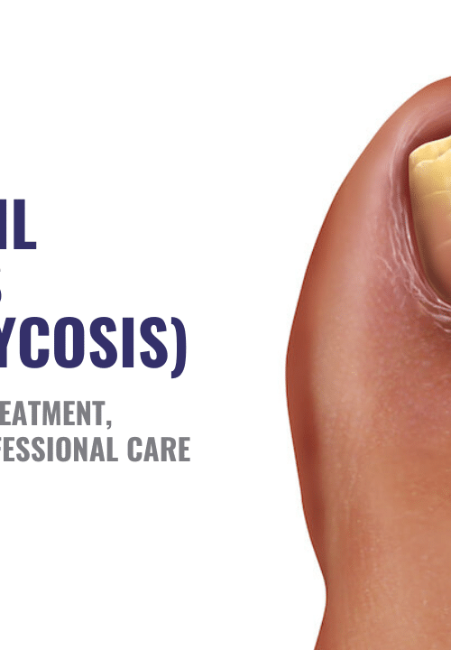 Fungal Nail Infections