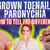 ingrown toenail vs paronychia