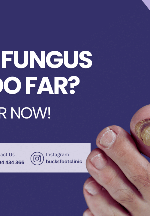 fungal toenail infection treatment