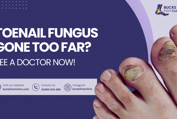 fungal toenail infection treatment