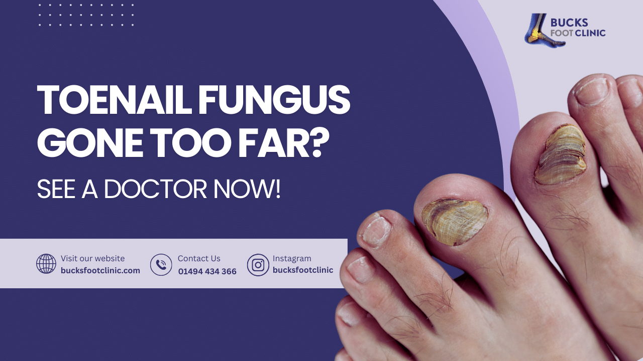 fungal toenail infection treatment