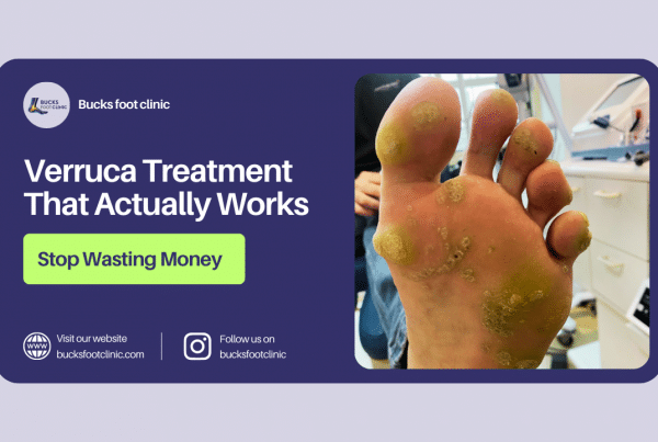 verruca treatment that works