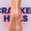 cracked heels treatment