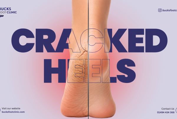 cracked heels treatment