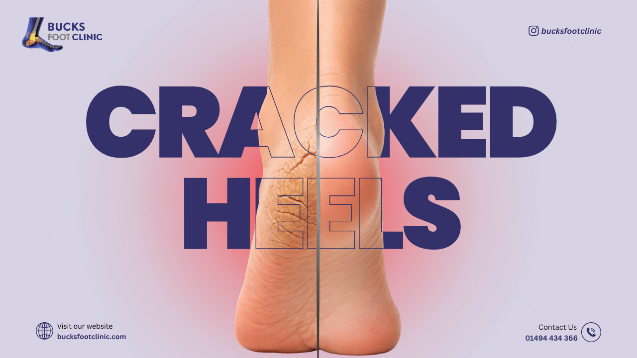 cracked heels treatment