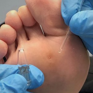 Verrutop Treatment